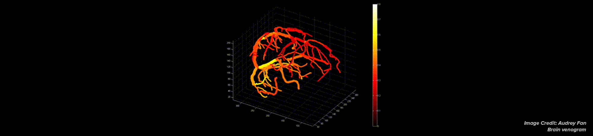Brain venogram